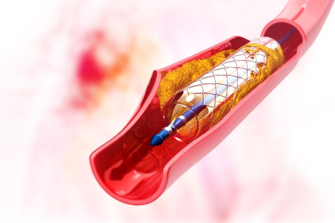 Stents - how they help your heart
